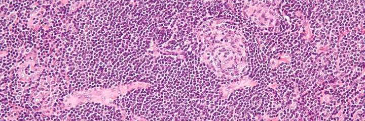 Castleman disease histology