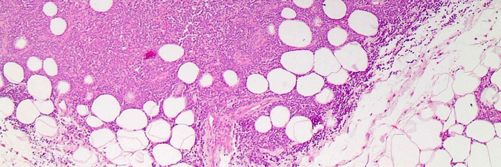 Breast marginal zone lymphoma